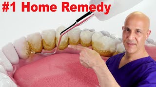 1 Home Remedy to Remove Dental Plaque amp Tarter to Prevent Cavities  Dr Mandell [upl. by Harewood]