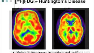 Advances in Alzheimers Disease Imaging and Biomarker Research [upl. by Zeret]