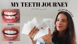 MY TEETH JOURNEY  Invisalign Composite Bonding Whitening  Answering All Your Questions [upl. by Erlewine]