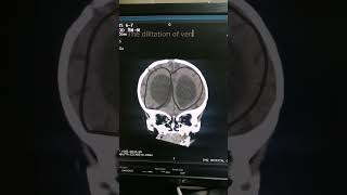 Hydrocephalus  Babay CT  Head anatomy  Findings of Head  Medical Imaging  Brain CT [upl. by Llessur148]