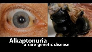 Alkaptonuria a rare genetic disease [upl. by Eelanej]