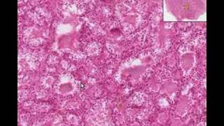 Histopathology ThyroidGraves Disease [upl. by Tasiana]