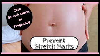 Preventing Stretch Marks In Pregnancy  Tips and Tricks to Avoid and Heal Stretch Marks [upl. by Oleusnoc159]