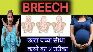 🤰Breech Presentation  उल्टा बच्चा सीधा करने का तरीका [upl. by Yraillih431]