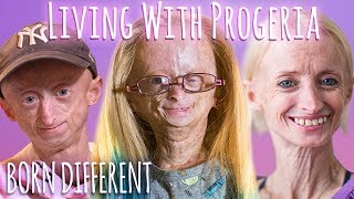 Living With Progeria 30 Min Documentary  BORN DIFFERENT [upl. by Bale]