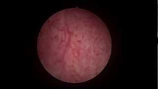 Endometrium just before periods [upl. by Hickie]