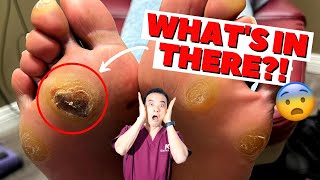 Guess Whats Hiding Under This Ulcer SURPRISE Inside 😲  Ulcer and Callus Removal  Dr Kim [upl. by Ainar]