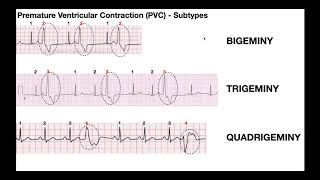 EKG Patterns  Premature Atrial amp Ventricular Contractions PACs amp PVCs [upl. by Ydroj96]