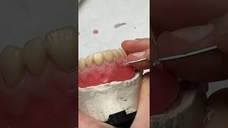 Wax Denture Festooning dental smile teeth lsk121shorts shortvideo shorts dentures [upl. by Corella]