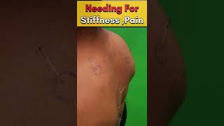 कमर दर्द ✅ गर्दन दर्द  dry needling for back pain backpain neckpain shorts health hindi [upl. by Rydder]