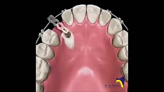 Canine Impaction dentistbracing orthodonticscanineimpactionImpactionExposureCanineexposure [upl. by Laktasic414]