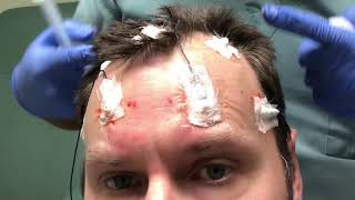 How to apply conductive gel to electrodes for athome EEG [upl. by Aylad]