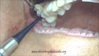 Buccally placed supernumerary molar tooth removal using elevator [upl. by Annwahs471]