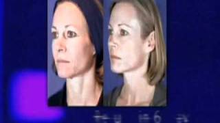 REJUVENATION FACIALE Laser CO2 Micro Fractionné MiXto Essonne [upl. by Oiled]