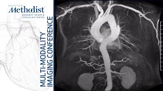 Diseases of the Aorta A MultiModality Approach Quiñones MD and ChamsiPasha MD March 9 2021 [upl. by Meit]