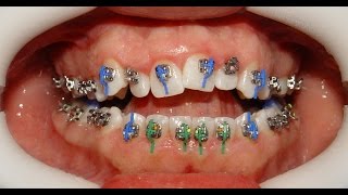 Orthodontic Treatment of Anterior Open Bite  Mahmoud 22yrs [upl. by Noryahs]