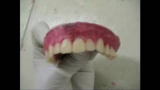 samiha 33 Festooning and sealing Upper trial denture [upl. by Yanahs427]