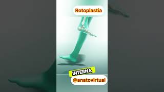 Rotoplastia [upl. by Annahavas846]