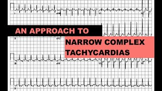 Narrow Complex Tachycardias  an approach [upl. by Rebme]