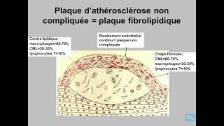 Athérosclérose Anatomie Pathologique Partie 2 [upl. by Norene850]