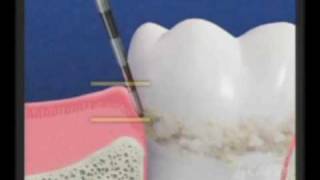 Periodontal disease  Gum disease  Dr Sahabi  Burbank [upl. by Ellswerth]