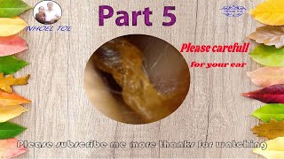 Impacted Earwax Removed Gracefully part5 [upl. by Miles]