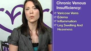 Chronic Venous Insufficiency Varicose Veins  VeinSense [upl. by Allehcim291]