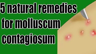 5 natural remedies for molluscum contagiosum  molluscum contagiosum Treatment [upl. by Tsui]