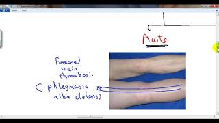 GENERAL PATHOLOGY 40  hyperaemia and oedema DR SAMEH GHAZY [upl. by Drannel]