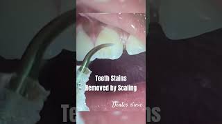 Shining Smiles Start Here ✨ Teeth Scaling Explained [upl. by Lenneuq]