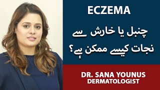 ChambalKharish Ka llaj  Eczema Ka Ilaj  How To Treat Eczema  Eczema Treatment  Dr Sana Younas [upl. by Marcus]