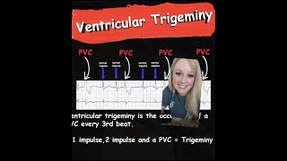 Ventricular Trigeminy  EMS Cardiology [upl. by Neroc]