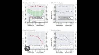 Audiogram Interpretation [upl. by Checani]