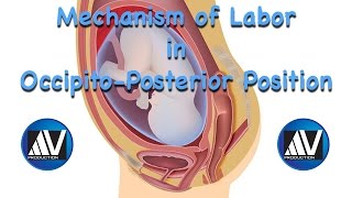 Mechanism of Labor in OccipitoPosterior Position [upl. by Jahncke502]