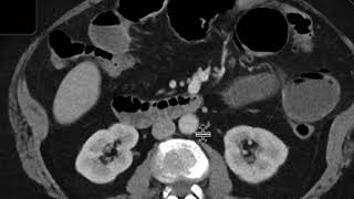 Gallstone ileus [upl. by Nonregla]