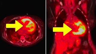 Young Man Takes BrandNew Vitamin K2 Supplement This Happened To His Heart [upl. by Mirella]