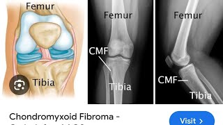 chondroblstoma Vs chondromxoid fibroma [upl. by Myles]