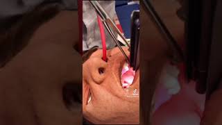 Tips for Nasal Intubation [upl. by Shurwood]