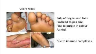 Oslers nodes and Janeway lesions [upl. by Syst]