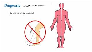 GuillainBarre Syndrome GBS Described Concisely [upl. by Desirae]