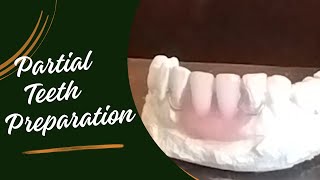 Partial teeth preparation  partial denture procedure  how to make partial denture step by step [upl. by Martin]