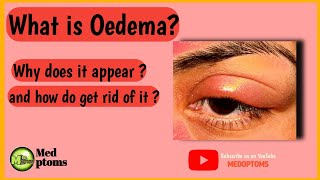 Oedema of eyelid  Swollen eyeStye Chalazion Hordeolum cellulitis dermatitis amp lid abscess [upl. by Tedmann]