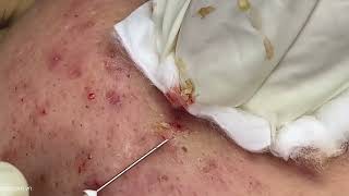 Big Cystic Acne Blackheads Extraction Blackheads amp Milia Whiteheads Removal Pimple Popping [upl. by Naloj96]