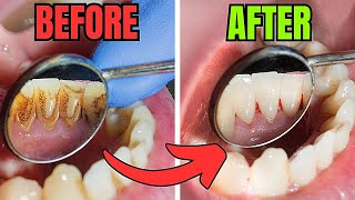 5 Tips to Remove Plaque and Tartar From Teeth [upl. by Eirojram225]