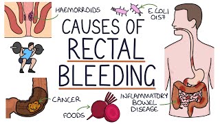 Understanding the Causes of Blood in Stool Rectal Bleeding [upl. by Ardnuhsal]