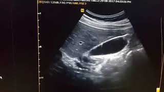 GB Adenomyomatosis Sonography [upl. by Natsirt]