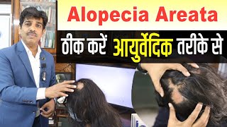 Scarring Alopecia Patient Live  Treatment of Lichen Plano Pilaris [upl. by Inasah]