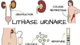 LITHIASE URINAIRE Signes et Symptômes diagnostic traitement  Complications [upl. by Rodger968]