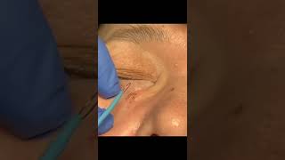 Quick amp Easy Filiform Wart Removal [upl. by Sosthina]