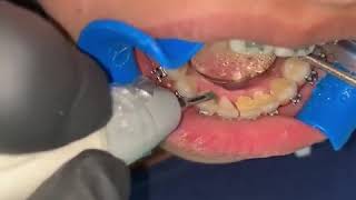 How to Remove Tartar amp Plaque from Teeth [upl. by Wyly]